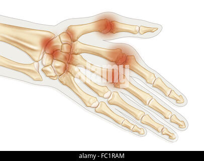 RHEUMATOIDE ARTHRITIS, ZEICHNUNG Stockfoto