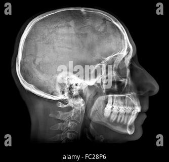 Menschlicher Schädel Röntgenbild Stockfoto