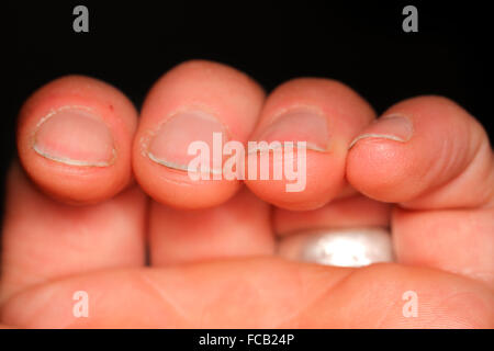 Schmutzige Fingernägel unregelmäßig. Stockfoto