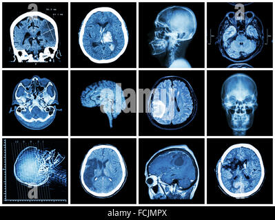 Sammlung von Erkrankung des Gehirns (CT und MRT des Gehirns: Hirninfarkt, Intrazerebrale Blutung, Hirntumor, basale zeigen Stockfoto