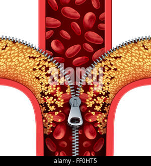 Arteriosklerose Therapie Arterien Konzept als ein Reißverschluss Öffnung Plaque-Bildung in einer verstopften Arterie als Symbol der medizinischen Behandlung Reinigung Reinigung verstopft Venen als Metapher für das Cholesterin zu entfernen. Stockfoto