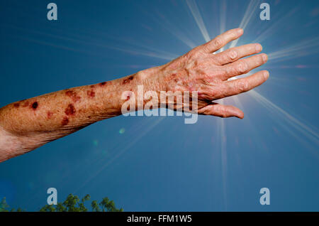 Arm von einem kaukasischen Mann nach Kryo-Therapie für die Sonnenflecken. Digital verändert. Stockfoto