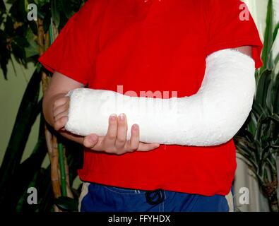 Hand in Gips Stockfoto