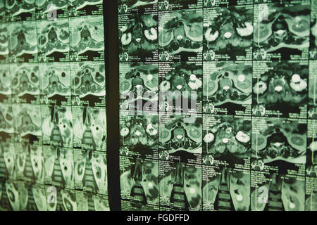 Computertomographie des Brustkorbs. Medizinischer Hintergrund. Stockfoto