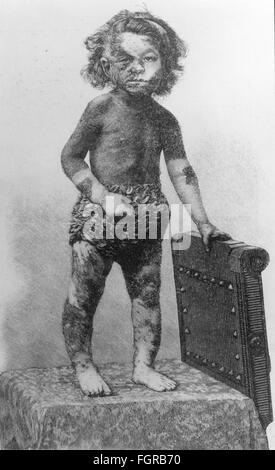 Hypertrichose, 19. Jahrhundert Stockfotografie Alamy