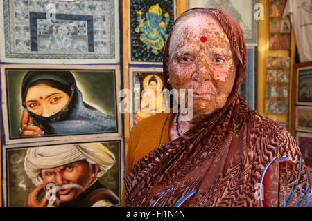 Frau mit Haut Krankheit namens "Vitiligo" in Jaisalmer, Indien Stockfoto