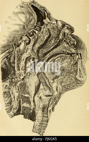 Erkrankungen der Nase und des Rachens; ein Lehrbuch für Studenten und Praktiker (1893) Stockfoto