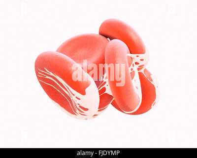 Arteriosklerose Stockfoto