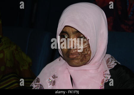 Dhaka, Bangladesch. 5. März 2016. Saure Überlebende besuchen die nationale Jahrestagung 2016 Shishu Academy organisiert von Acid Survivors Foundation in Dhaka am 5. März 2016. In Bangladesch wurden 3625 Menschen Opfer der Säureattacken in 3270 Vorfälle Since1999.  1847 waren weiblich, 901 waren männlich und 877 waren Kinder, nach der ASF. Bildnachweis: Rehman Asad/Alamy Live-Nachrichten Stockfoto