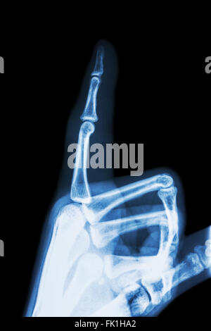 Film x-ray Zeigefinger und Hand (zeigen mit dem Finger) Stockfoto