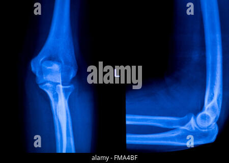 Unterarm, arm und Ellbogen Verletzungen Xray Scan Test Reults um Schmerzen Quelle zu diagnostizieren. Stockfoto