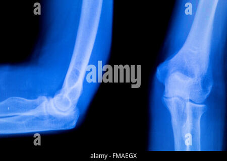 Unterarm, arm und Ellbogen Verletzungen Xray Scan Test Reults um Schmerzen Quelle zu diagnostizieren. Stockfoto