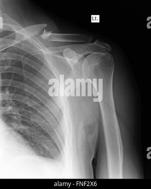 Röntgen der menschlichen Schulter Stockfoto