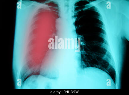 Röntgenuntersuchung der Brust für die Diagnose der Lungentuberkulose Infektion Stockfoto