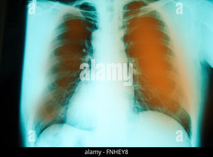 Röntgenuntersuchung der Brust zur Diagnostik pulmonaler Tuberkulose-Infektion mit beiden Lungen Stockfoto