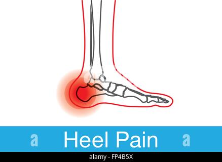 Ferse Schmerzen Gliederung Stock Vektor