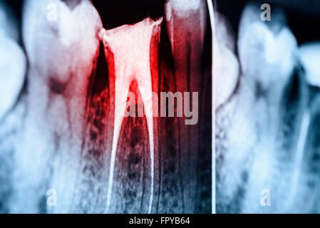 Volle Füllung des Wurzelkanals Systeme auf Zähne Röntgen Stockfoto