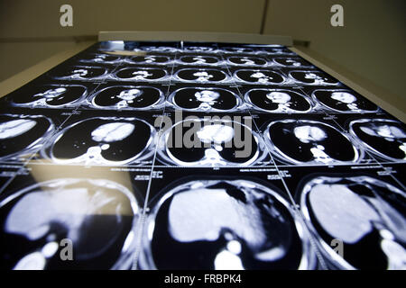 Ergebnisse der Computertomographie in ICU lightbox Stockfoto