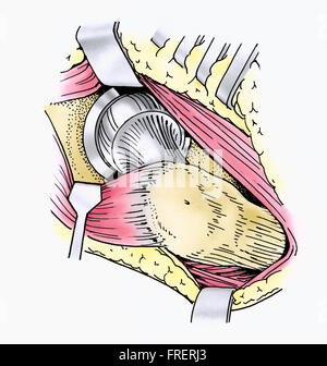 Das Diagramm zeigt Femorale Komponente und Becken-Socket an Ort Stockfoto