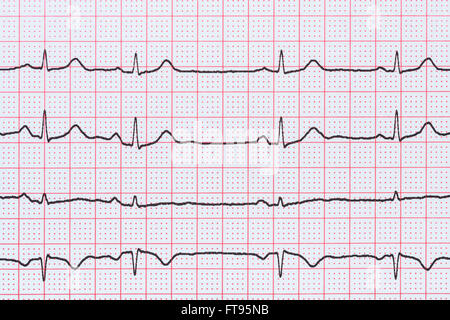 Sinusrhythmus Herz auf Elektrokardiogramm Rekord Papier zeigt normale P-Welle, PR und QT-Intervall und QRS-Komplex Stockfoto