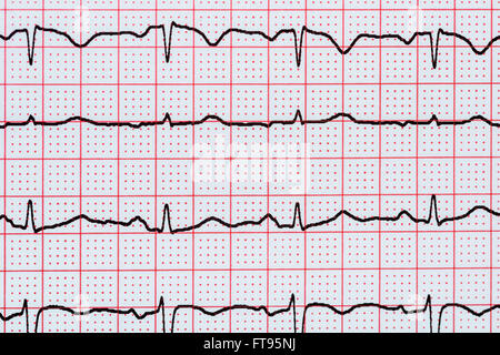 Sinusrhythmus Herz auf Elektrokardiogramm Rekord Papier zeigt normale P-Welle, PR und QT-Intervall und QRS-Komplex Stockfoto