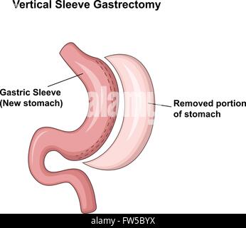 Illustration der vertikalen Sleeve-Gastrektomie (VSG) Stock Vektor