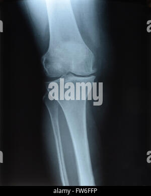 Röntgen Sie Abbildung der Kniegelenke Stockfoto