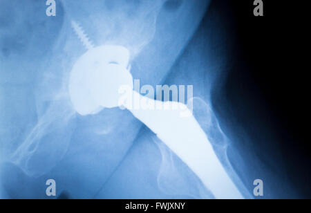 Hüftgelenkersatz Verletzungen medizinische Röntgen-Scan Testergebnis für Erwachsene zeigt orthopädische Traumatologie Metallplatte Titanimplantat mit Kugel-Gelenk- und Schrauben-Bild. Stockfoto