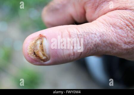 geschwollene Finger ohne Fingernagel Stockfoto