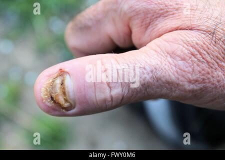 geschwollene Finger ohne Fingernagel Stockfoto