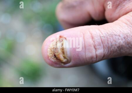 geschwollene Finger ohne Fingernagel Stockfoto