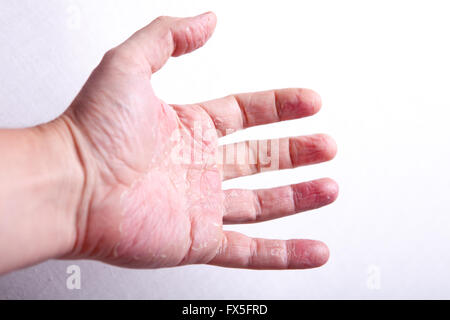 allergische Dermatitis Hautausschlag Hautbeschaffenheit des Patienten Stockfoto