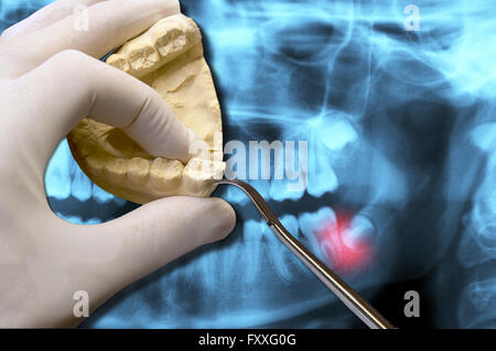 Zahnarzt zeigen Zahnschmerzen Weisheit und molare Zähne über x-ray Stockfoto