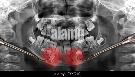 Dental-Scan Anzeige Milchzähne Milchzähne, Wachstum Zähne Ausbruch Stockfoto