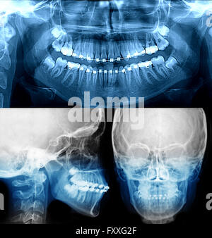 Zahnröntgen mit geschweiften Klammern fixiert Gerät kieferorthopädische Versorgung Stockfoto