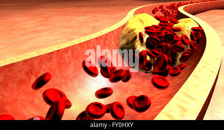 Verstopfte Arterie mit Thrombozyten und Cholesterin Plaque. Atherosklerose. Faserige Plaquebildung. Stockfoto