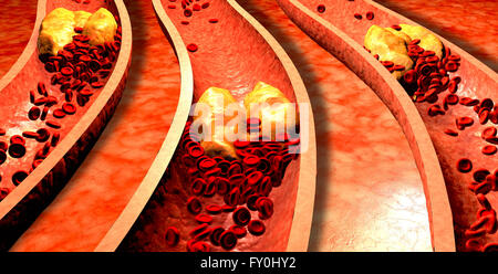 Verstopfte Arterie mit Thrombozyten und Cholesterin Plaque. Atherosklerose. Faserige Plaquebildung. Stockfoto