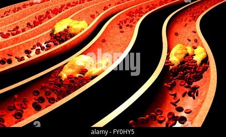 Verstopfte Arterie mit Thrombozyten und Cholesterin Plaque. Atherosklerose. Faserige Plaquebildung. Stockfoto