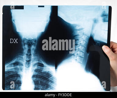 x - Ray der zervikalen Platte einer Person Stockfoto