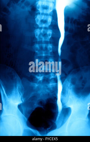 NIEREN-KOLIK, X-RAY Stockfoto