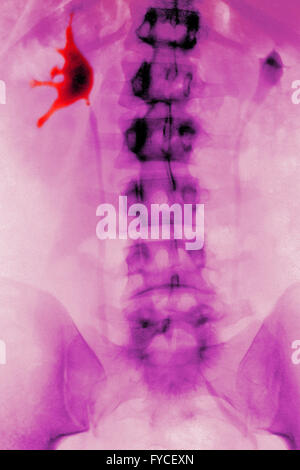 NIEREN-KOLIK, X-RAY Stockfoto