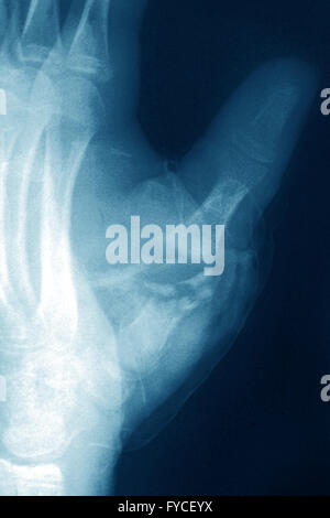 GEBROCHENEN FINGER, X-RAY Stockfoto