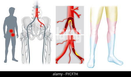 ARTERIELLE STENOSE Stockfoto