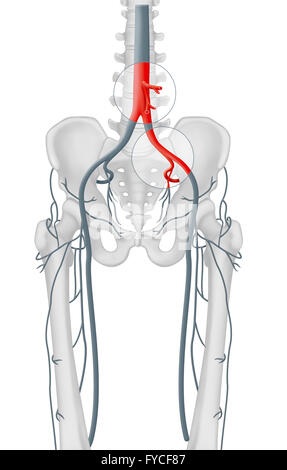 ARTERIELLE STENOSE Stockfoto