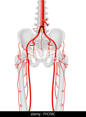 ARTERIELLE STENOSE Stockfoto