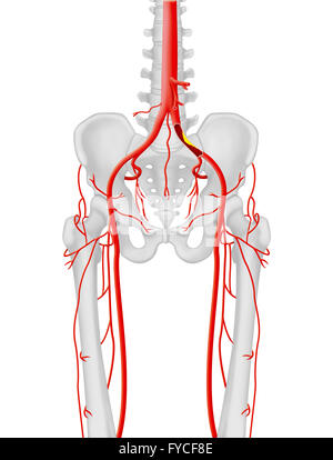 ARTERIELLE STENOSE Stockfoto