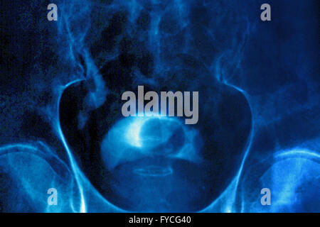 PROSTATA-ADENOM, X-RAY Stockfoto