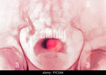 PROSTATA-ADENOM, X-RAY Stockfoto