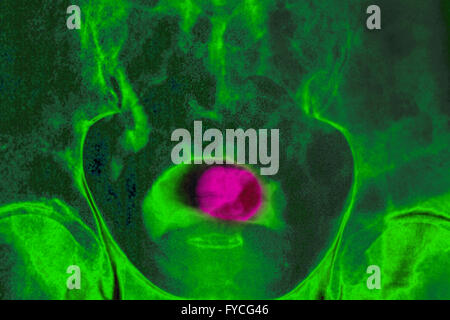 PROSTATA-ADENOM, X-RAY Stockfoto