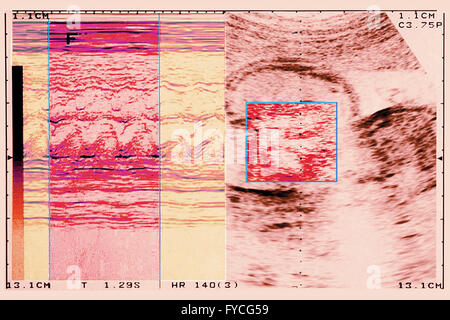 FÖTUS-ULTRASCHALL Stockfoto